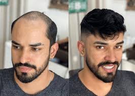 Hair System vs. Hair Transplant: Which One is Right for You?