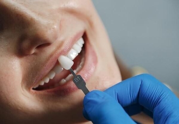 The Necessity Of Understanding The Concept Of Dental Lumineers Veneers In Ottawa