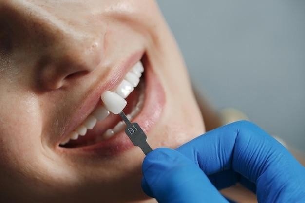 The Necessity Of Understanding The Concept Of Dental Lumineers Veneers In Ottawa