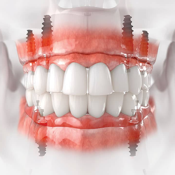 How Do All-on-4 Implants Restore a Full Arch of Missing Teeth?
