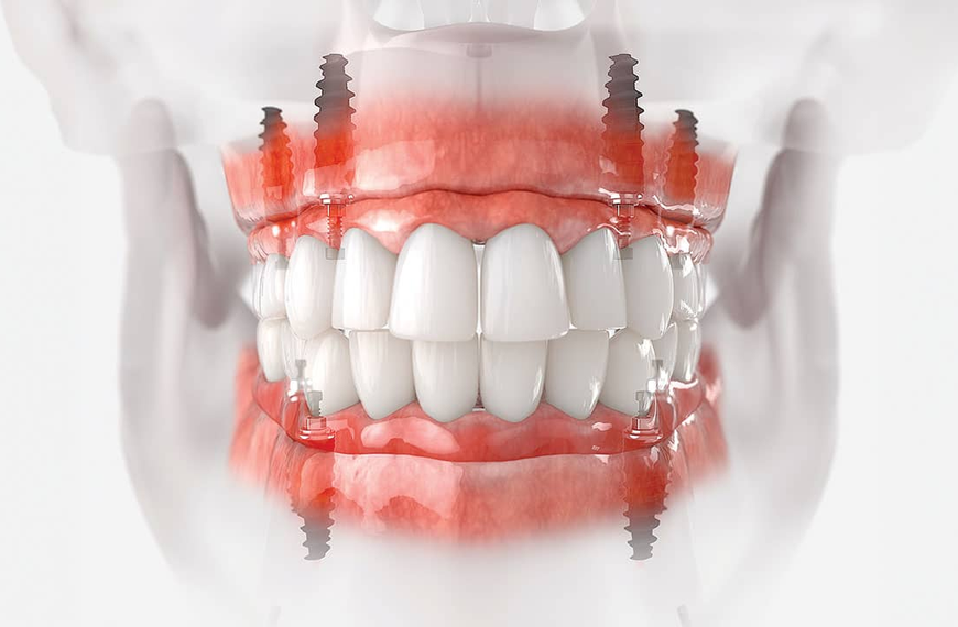 How Do All-on-4 Implants Restore a Full Arch of Missing Teeth?