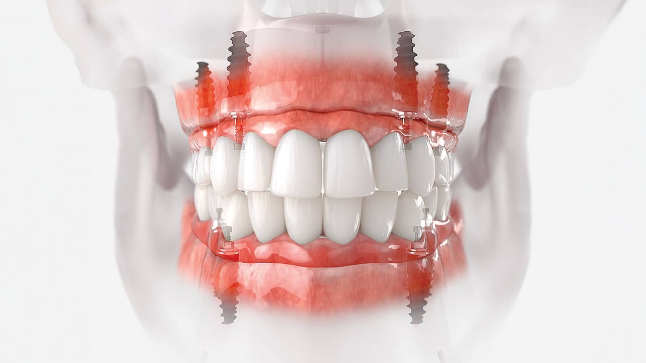 How Do All-on-4 Implants Restore a Full Arch of Missing Teeth?